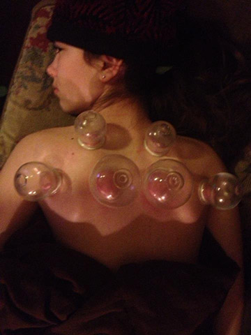 a patient has glass cups on their back for cupping procedure